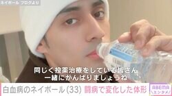 白血病公表のネイボール（33）、闘病で7.2キロ減ってしまった体形のビフォーアフター「退院後は62.8キロでした」