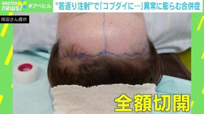 【写真・画像】“若返り注射”でおでこが膨らみ「コブダイ」に！？ 当事者「よくこれで生きてたな。額の限界を感じた…」 PRP＋bFGFとは？　4枚目