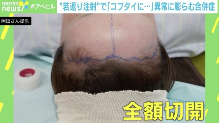 【写真・画像】“若返り注射”でおでこが膨らみ「コブダイ」に！？ 当事者「よくこれで生きてたな。額の限界を感じた…」 PRP＋bFGFとは？　4枚目