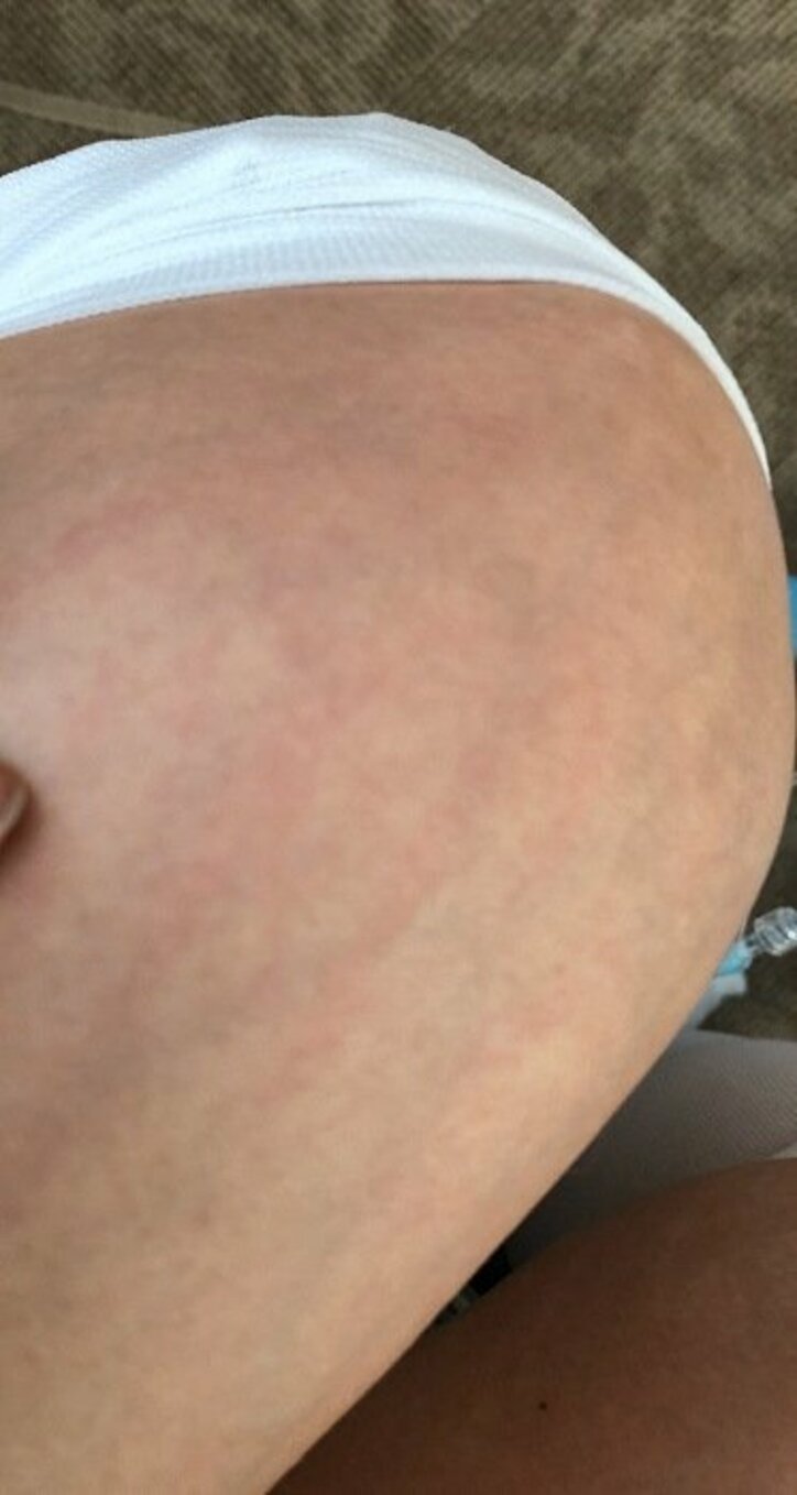 キンタロー。出産後の激しいかゆみで助産師に思わぬお願い事「めちゃくちゃ止められました」