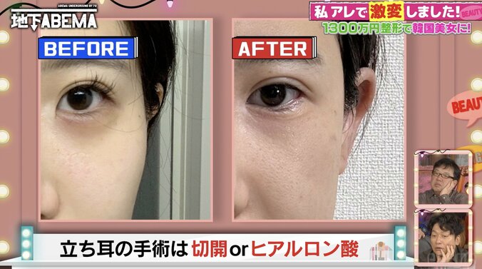【写真・画像】整形総額1300万円の美女、“立ち耳”整形の効果を明かす「1年で元通りになってしまったけど…」　2枚目