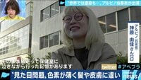 アベマ世代に贈る!厳選ニュース特集! - マイノリティ - “見た目問題”は“見る目問題”!? 生まれつき色素が薄いアルビノ当事者の苦悩とは? | 動画視聴は【Abemaビデオ(AbemaTV)】