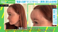 “若返り注射”でおでこが膨らみ「コブダイ」に！？ 当事者「額の限界を感じた…」