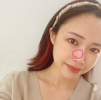 浅田好未『7月に取ったシミとホクロの経過』