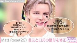 Matt Rose、目元と口元の整形を修正「慎重に打つ場所と打つ量を考えた方がいい」