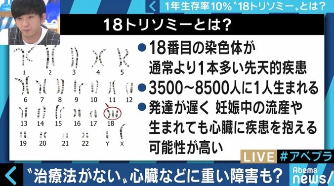 “1年以上の生存率は10％”…18トリソミー児の家族たちが写真展に託した苦悩と葛藤 2枚目