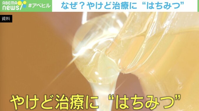 やけども回復？“はちみつ”の秘めたパワー… 医師「研究段階のため従来の方法で治療を」 1枚目