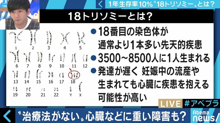 “1年以上の生存率は10％”…18トリソミー児の家族たちが写真展に託した苦悩と葛藤