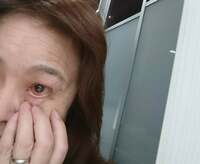 大島奈保美『結膜下出血について』