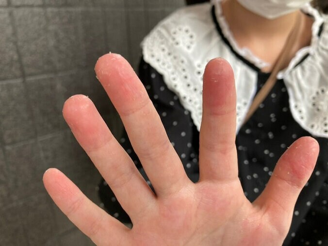 ノッチの妻、次女の手の症状について医師に相談「乾燥すると、ひび割れて出血」 1枚目