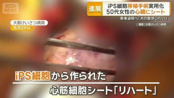 iPS細胞から作製された心筋細胞シート「リハート」
