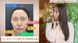 「ママ、ホラーマンに似てる」で整形を決意…30代ママの整形ビフォーアフターに驚きの声「ナチュラル！」「若返り！」