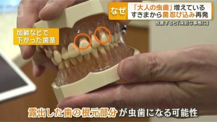 加齢などで歯茎が下がると…
