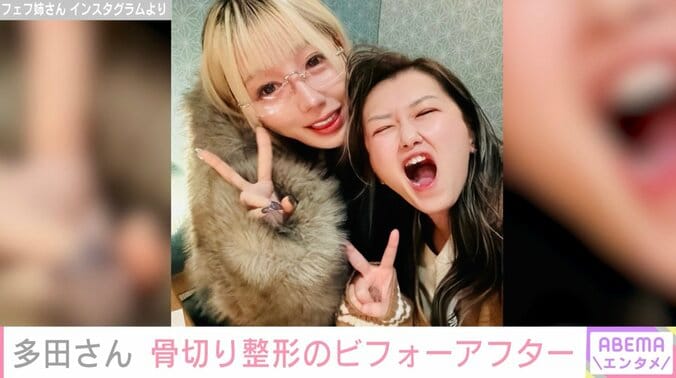 【写真・画像】『月曜から夜ふかし』フェフ姉さんの友人・多田さん、両あご&輪郭骨切り整形のビフォーアフターを公開「顔小さくなった」　1枚目