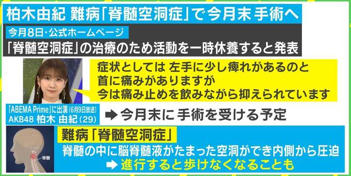 「右腕がゴムのように…」柏木由紀も患う難病“脊髄空洞症” 手術経験者が明かす初期症状