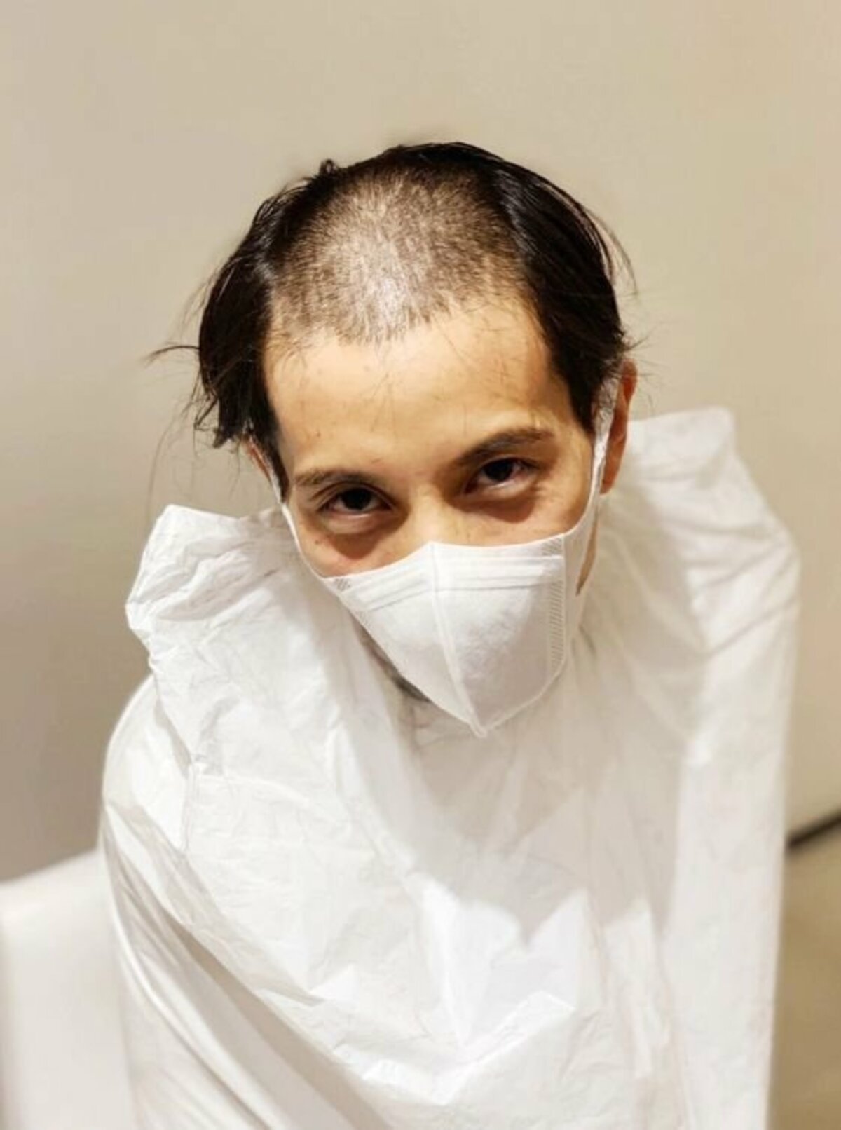 糖尿病などによる「重症下肢虚血症」の革新的治療法を開発 医師