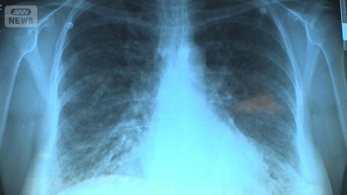 「いまも謎だらけ」ハンタウイルス研究・治療の最前線を取材　ナバホ族の知恵とは 1枚目