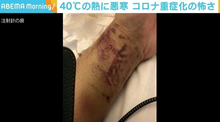 40度の熱に悪寒、酸素マスクも必要になり「死にそう」 実名で語るコロナ重症化の怖さ