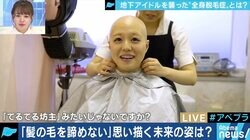 「頭が丸くても続けたい」…全身脱毛症アイドル、告白の裏にファンの後押しも