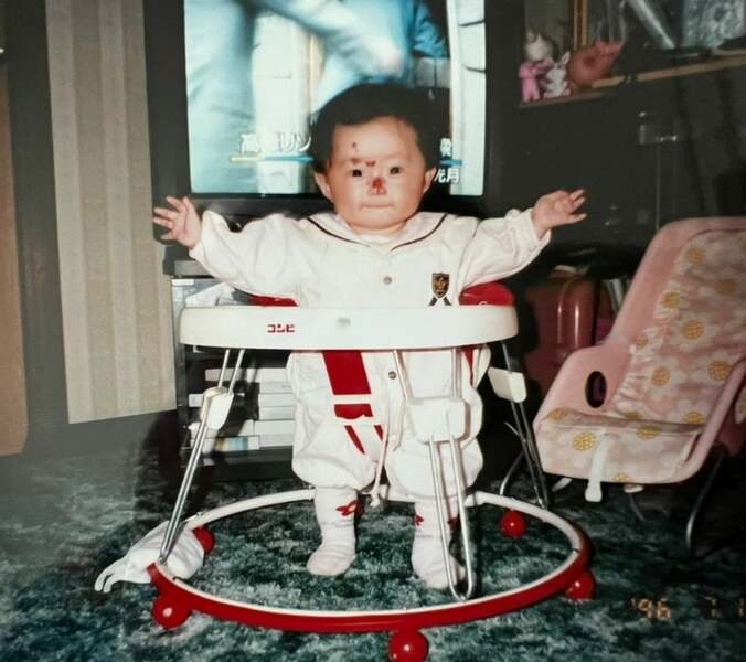 梅津真里奈さん、ちょっとした衝撃で皮膚が剥けてしまう難病の症状について明かす「顔には傷ができないの？」 1枚目