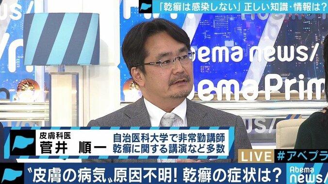 患者が告白「結婚は難しいと言われショックを受けた」　道端アンジェリカも誤解と偏見に苦しむ「乾癬」とは 5枚目