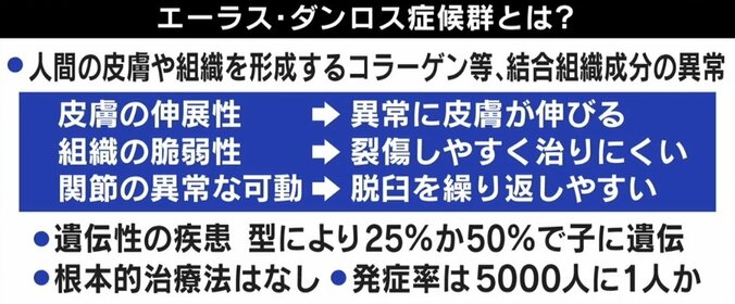 「何もできないと決めつけないで」エーラス・ダンロス症候群とは？ 当事者が明かす症状 2枚目