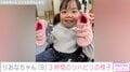 手術で胸から下がまひ りおなちゃん（9）、3時間頑張ったリハビリの様子