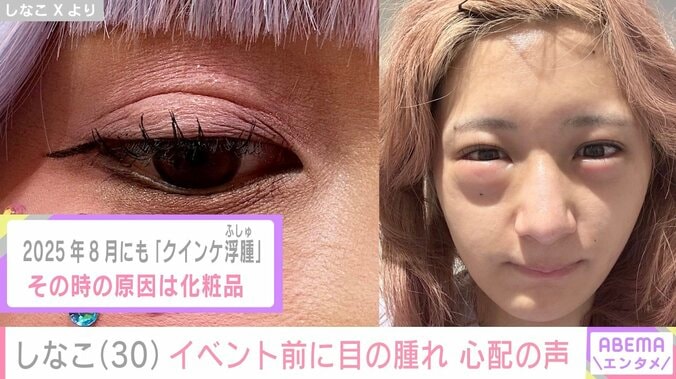 しなこ（30）、「閲覧注意」目元や唇が腫れた姿を公開し心配の声「休んで欲しい」「点滴までしたなんてつらかったよね」 4枚目