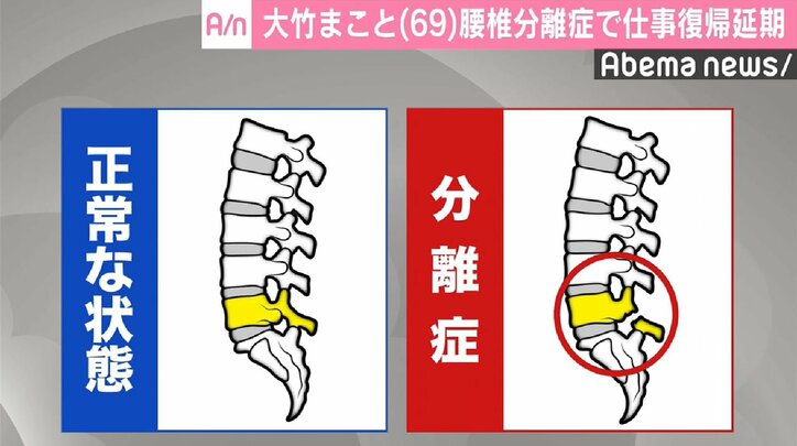 大竹まこと、腰椎分離症で復帰延期 腰の痛みに耐え生放送も… | 国内 | Abema Times