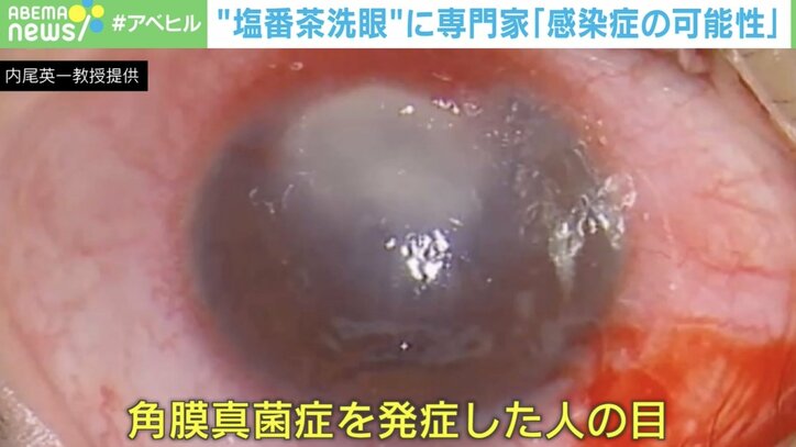 【写真・画像】SNSで広がる“塩番茶洗眼”は危険すぎる! 専門家「角膜真菌症に感染すると角膜移植が必要」…世にあふれる民間療法のリスクに気づくには 2枚目