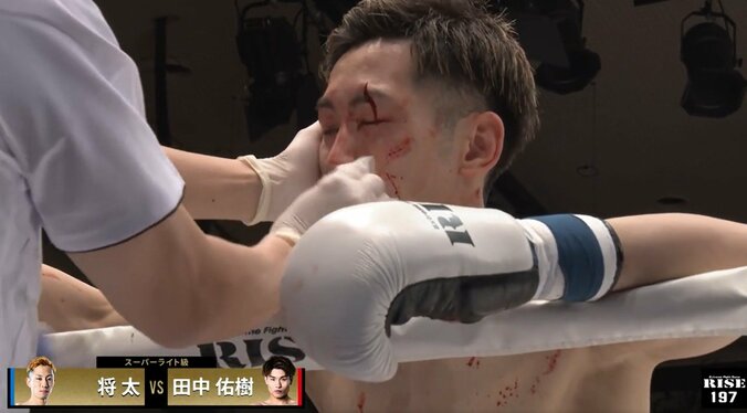 「映像でお見せできない」「眉毛が縦に割れた」ドクターも思わず顔をしかめた衝撃光景に実況アナと現王者も絶句 2枚目