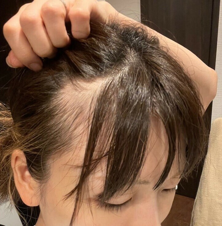  あいのり・桃、産後の抜け毛＆うねりが始まり「自己責任で、お願いする事にしました」 