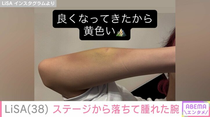 黄色く腫れた腕