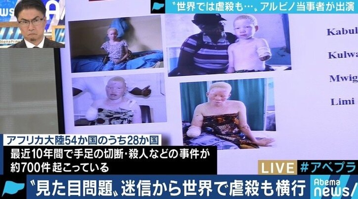 生まれつき色素が薄いアルビノ当事者の苦しみ「カラーコードに合わないから‥」バイト・就職を断られるケースも