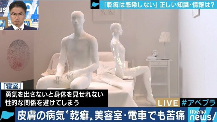 患者が告白「結婚は難しいと言われショックを受けた」 道端アンジェリカも誤解と偏見に苦しむ「乾癬」とは