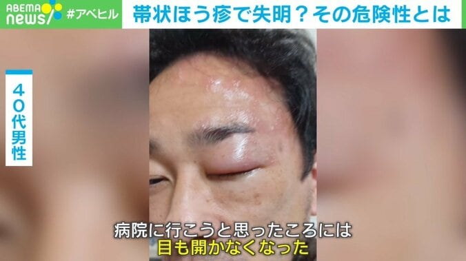 帯状疱疹で失明？ 疲れとストレスがトリガーに 1枚目