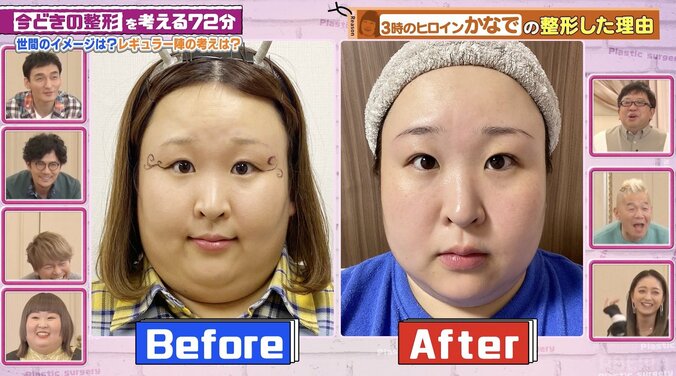 【写真・画像】3時のヒロイン・かなで、整形ビフォーアフターを公開「自然」「めちゃくちゃうまい」整形総額6000万円タレントも絶賛　1枚目