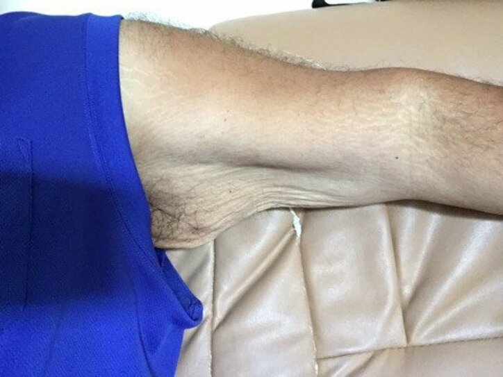 安田大・HIRO、85キロ痩せて余った皮に悩み始める「プルプル出来る」