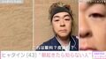 ヒャダイン、アレルギー症状で顔が変化「朝起きて鏡見たら知らない人でした」腫れたまぶたに心配の声