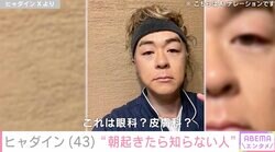 ヒャダイン、アレルギー症状で顔が変化「朝起きて鏡見たら知らない人でした」腫れたまぶたに心配の声