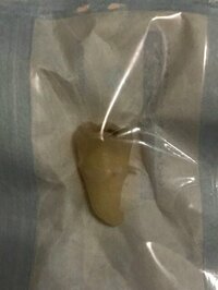 田中卓志（アンガールズ）『親知らず抜きました！』