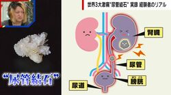 「ブラックコーヒーを…」「サウナで追い込み」世界3大激痛 尿管結石になりやすい人は？予防はできる？医師が解説