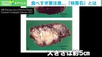 原因は“柿の食べ過ぎ”? 体内にできた「柿胃石」