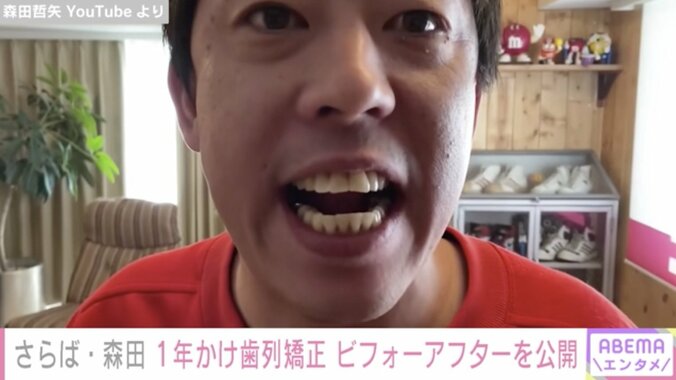 さらば青春の光・森田、麒麟・川島に「マチュピチュ」と例えられた歯並びを1年かけ矯正「めっちゃ良くない？」 1枚目