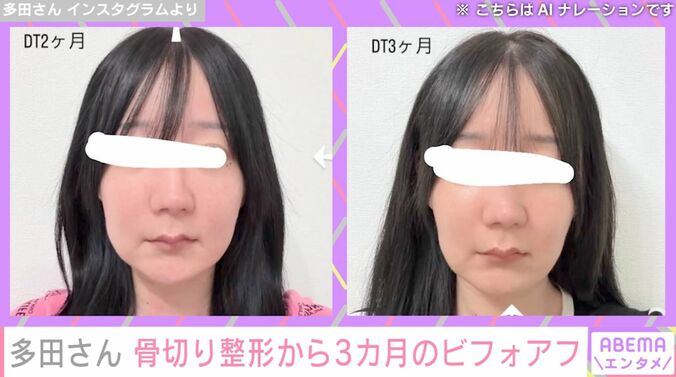 『月曜から夜ふかし』フェフ姉さんの友人・多田さん、両あご&輪郭骨切り整形から3カ月後の姿を公開「感覚はいまだにありません」 4枚目