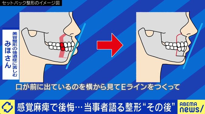 「口元の感覚がなくなって…」美容整形後のリスク “後遺症”患者増加に医師が警鐘 4枚目