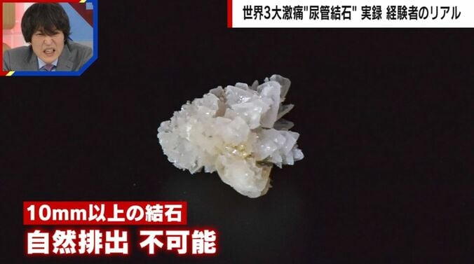 10ミリ以上の結石 自然排出 不可能