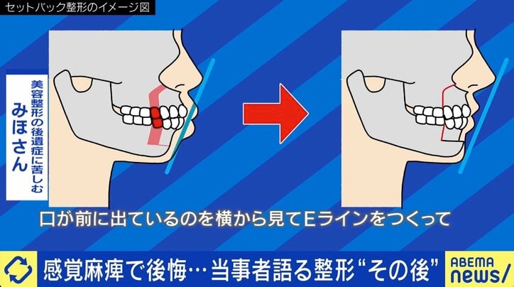 「口元の感覚がなくなって…」美容整形後のリスク “後遺症”患者増加に医師が警鐘