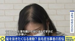 中学受験のストレスで発症してしまう小学生も…「気付いたら周りが頭髪だらけに…」やめたいのにやめられない“抜毛症”に悩み続ける女性