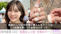 有村藍里、“皮膚むしり症”対策のテープ購入 同じ悩みを持つ人に向けて発信